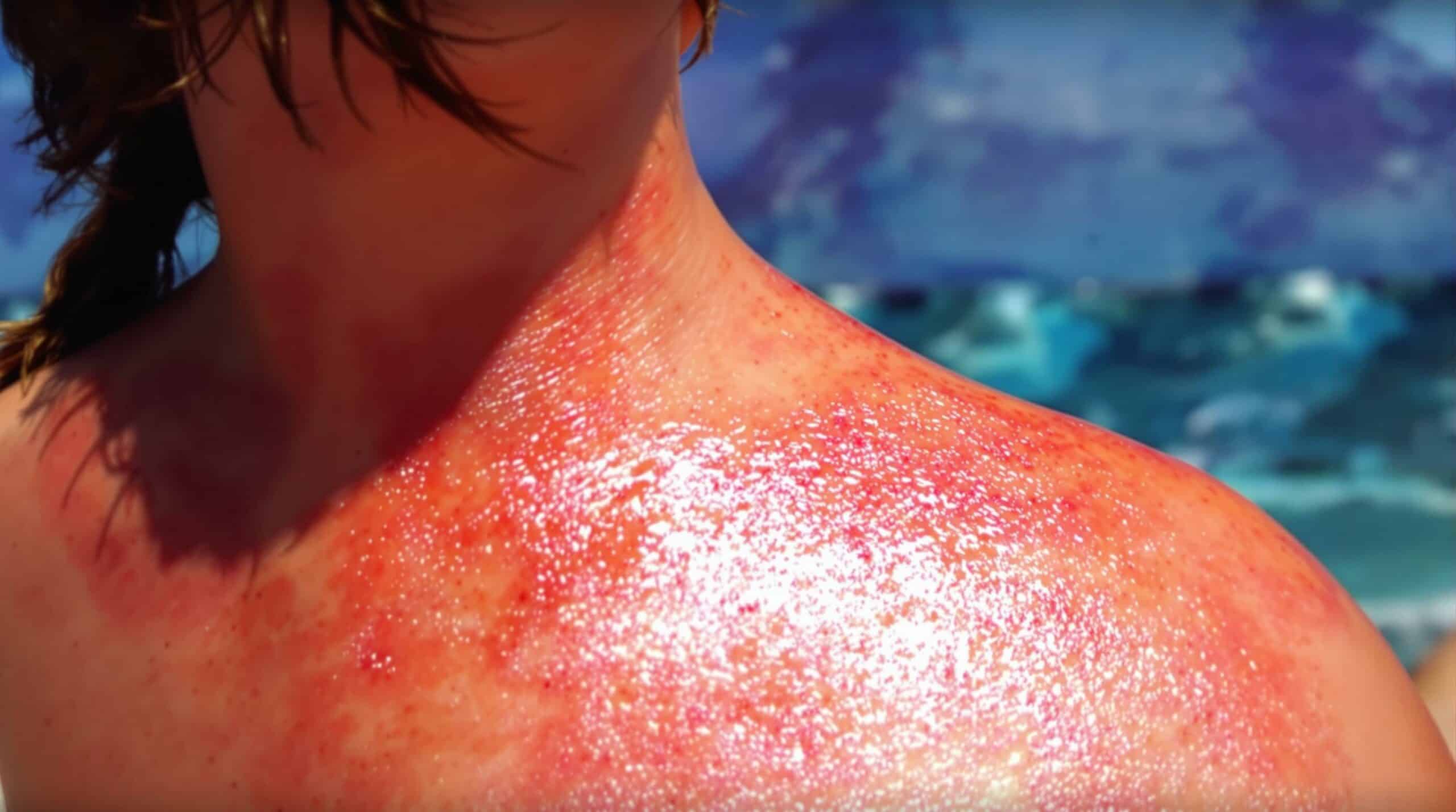 Brûlure : Réactions allergiques et brûlures